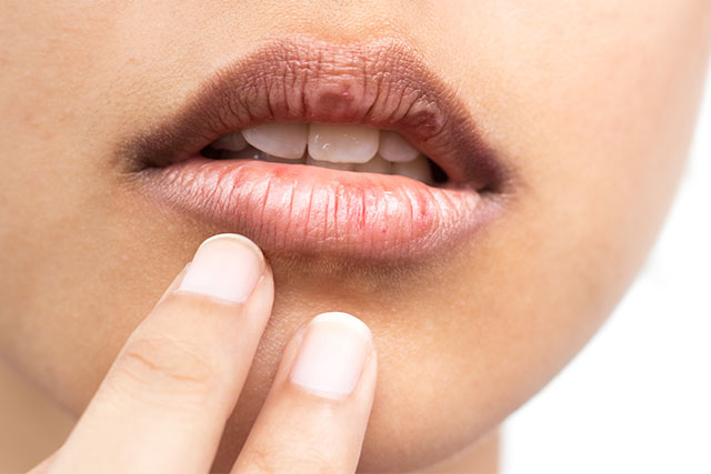 4 Alasan Kenapa Kulit Bibir Mengelupas yang Perlu Kamu Perhatikan