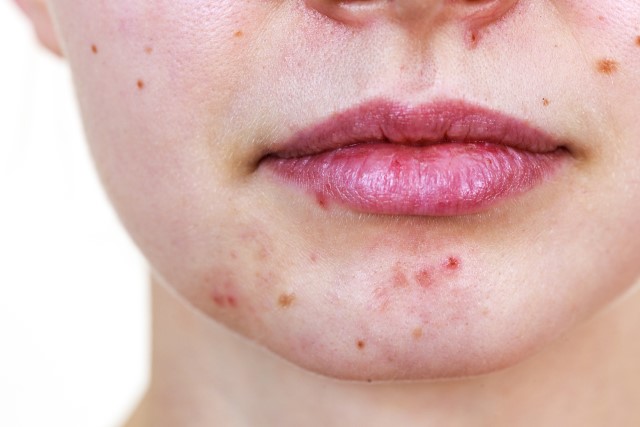 Kenali Ciri-Ciri Acne Prone Skin dan Cara Mengobatinya