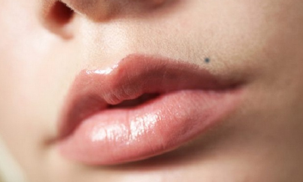 Penyebab Flek Hitam di Atas Bibir seperti Kumis dan Cara Mengatasinya
