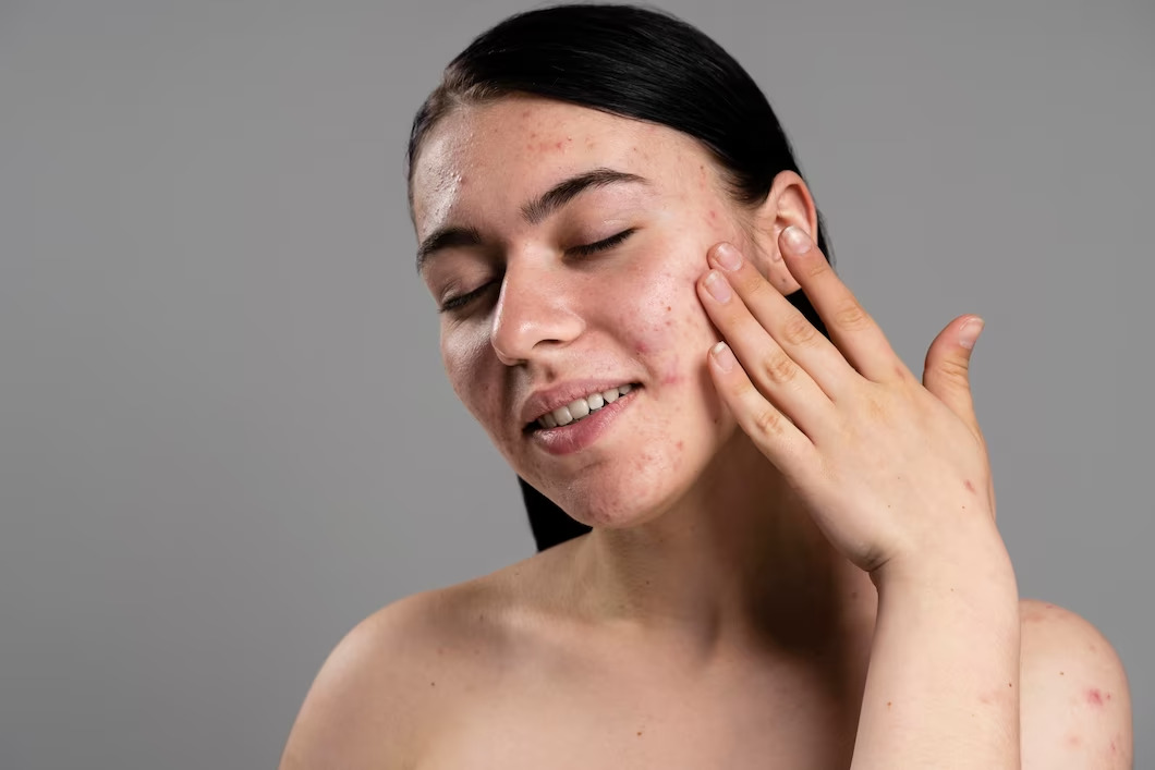 Cara Merawat Wajah Berminyak Secara Sederhana, Tak Perlu Banyak Skincare!