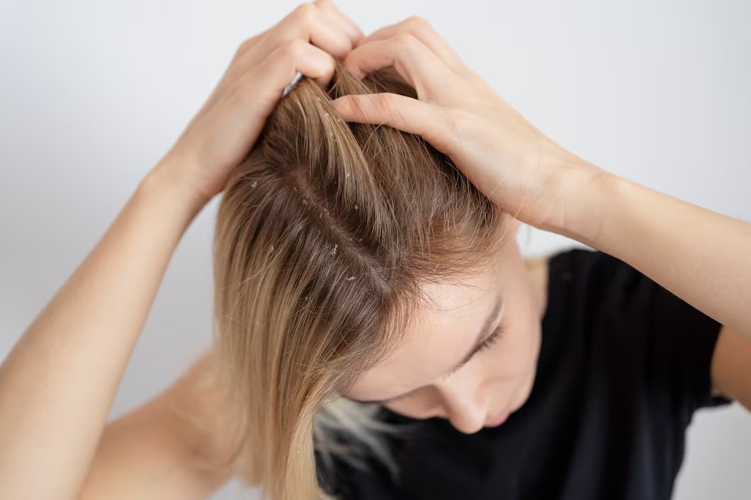 Penyebab & Cara Menghilangkan Ketombe Secara Alami pada Rambut Berhijab