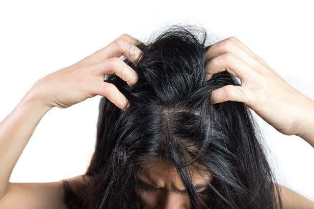 Tips Ampuh Mengatasi Masalah Rambut Ketombe