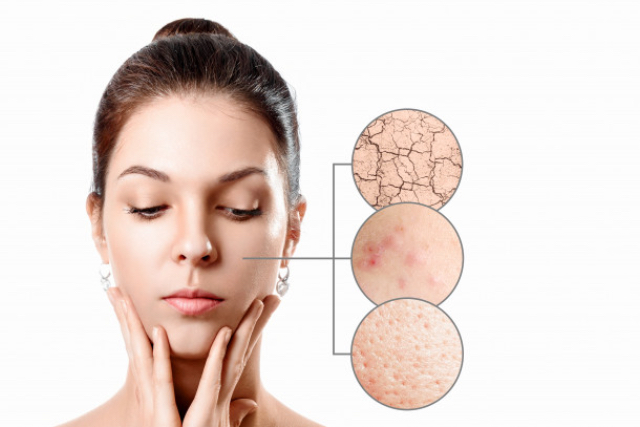 Tips Perawatan Kulit Dalam Mengatasi Skin Barrier yang Bermasalah