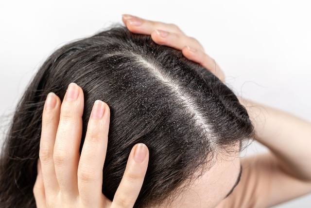 Tips dan Perawatan yang Efektif dalam Mengatasi Rambut Ketombe