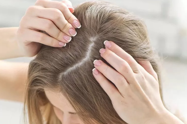 Memahami Kesalahan Umum dalam Perawatan Rambut yang Menyebabkan Ketombe