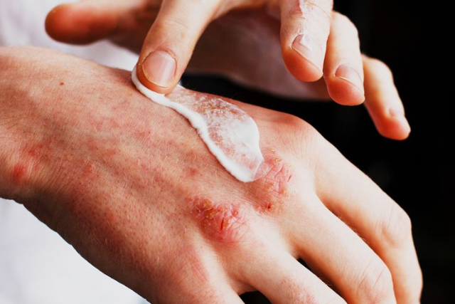 Tips Perawatan Kulit untuk Mengatasi Eczema