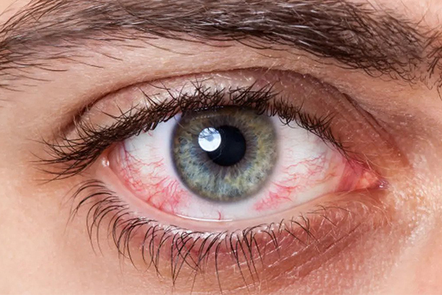 Penyebab dan Cara Mengobati Bercak Merah pada Mata, Jangan Panik Ya!
