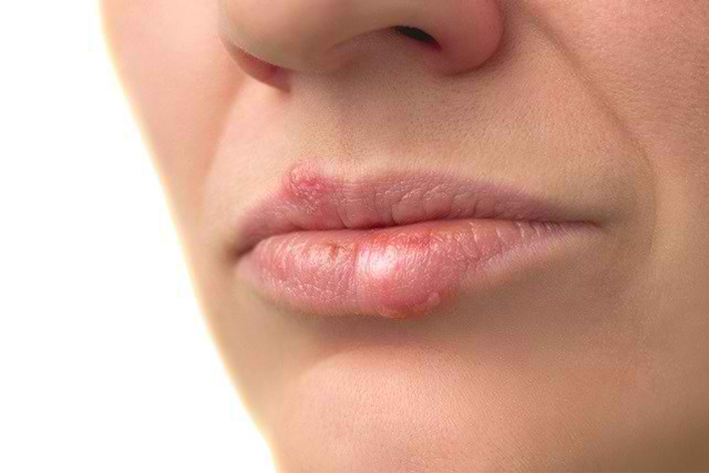 Penyebab Bibir Melenting dan Cara Mengobatinya