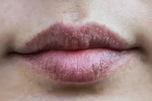 Bibir Hitam karena Lipstik? Ini 9 Cara Mengatasinya