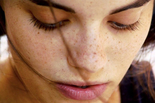 Penyebab Freckles di Wajah dan Cara Mencegahnya