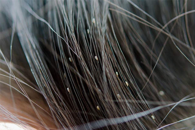 Penting! Ini 4 Cara Menghilangkan Kutu Rambut dengan Minyak Kayu Putih