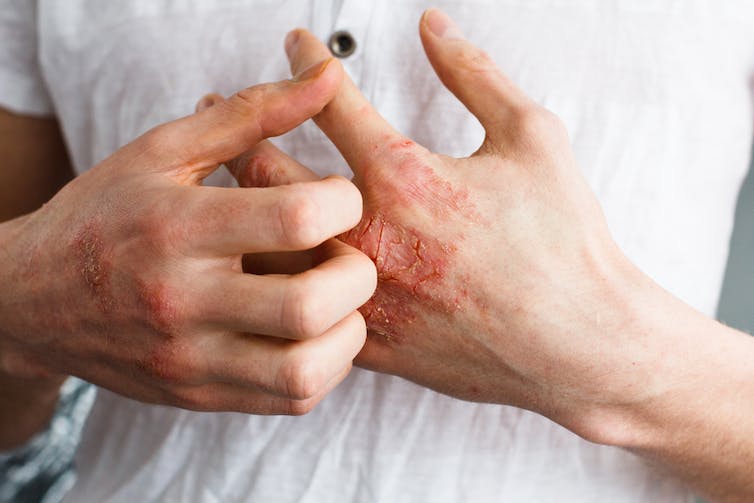 Penting untuk Diwaspadai! Simak Jenis-jenis Alergi Kulit dan Penyebabnya Berikut