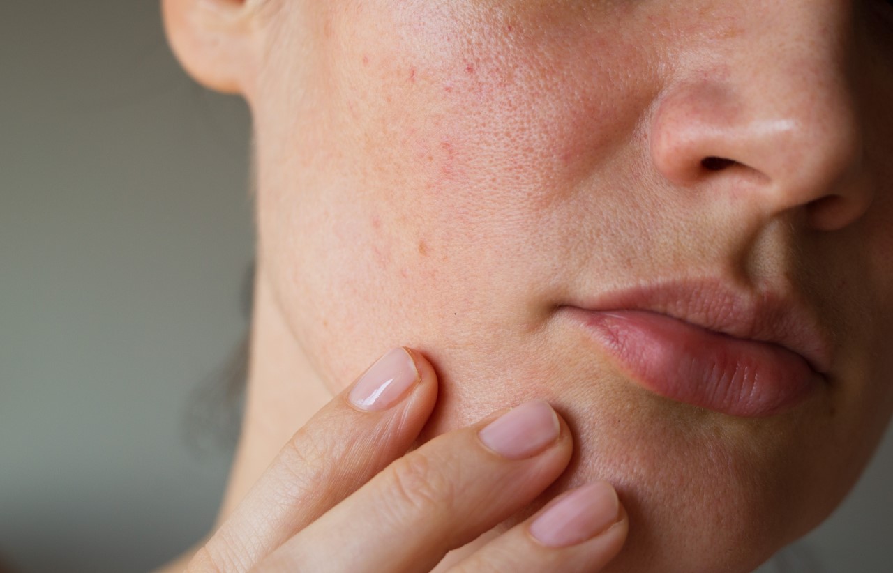 Skincare Routine untuk Menghilangkan Kulit Wajah yang Bruntusan