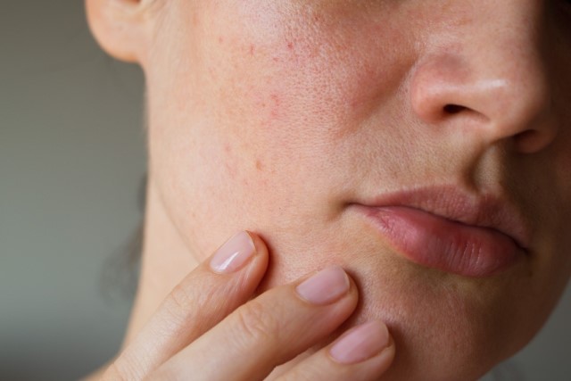 Faktor Penyebab Kenapa Wajah Gatal Setelah Memakai Skincare dan Cara Mengatasinya