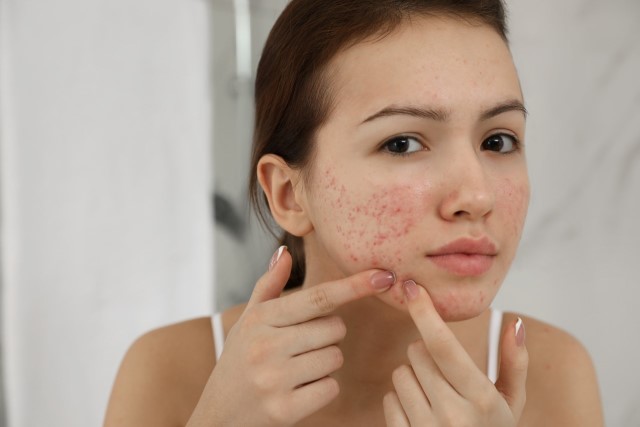 Simak Cara Mengatasi Wajah Bruntusan Akibat Skincare Agar Kulit Kembali Sehat