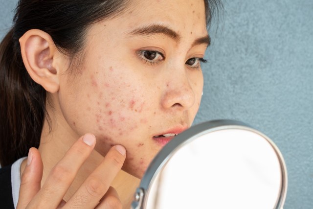 Fakta, Cara, dan Rekomendasi Skincare untuk Mengatasi Kulit Berjerawat