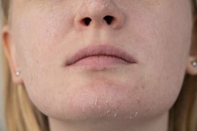 Rekomendasi Produk Skincare yang Cocok untuk Kulit Sensitif dan Kering
