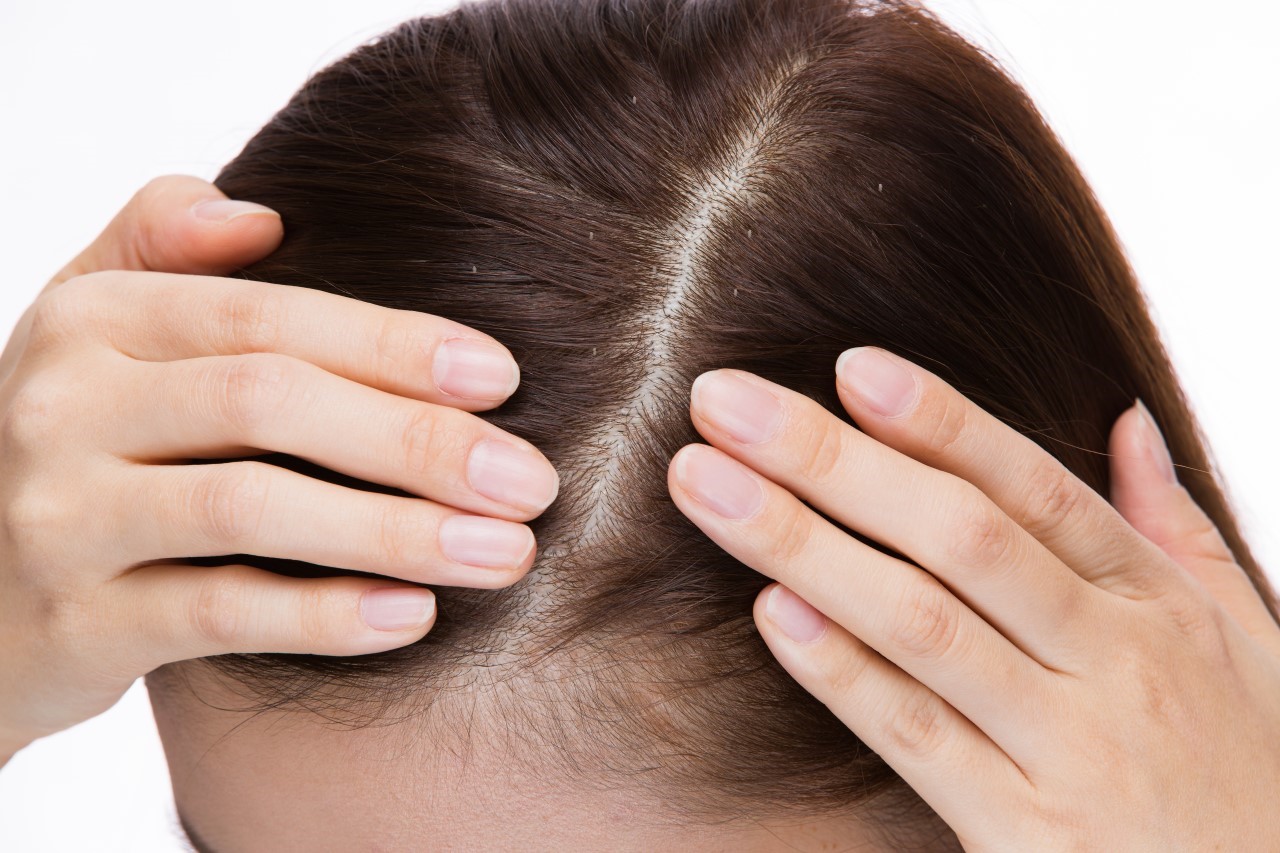 Perawatan Rambut Berketombe dengan Natur Anti Dandruff Treatment Series