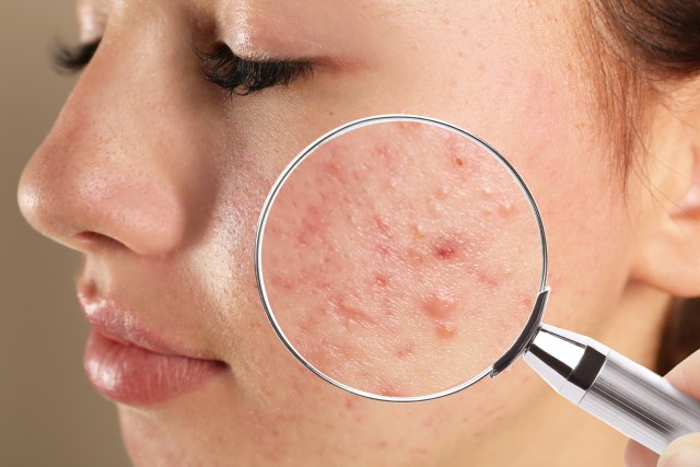 4+ Rekomendasi Skincare untuk Fungal Acne agar Tidak Semakin Parah
