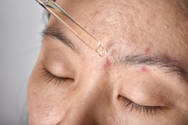 Kenali 5 Kandungan Skincare Untuk Kulit Berjerawat yang Aman