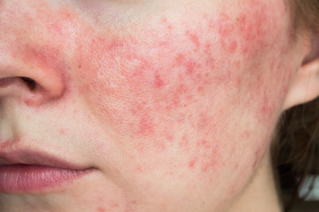 Memahami Rosacea dan Cara Mengatasinya