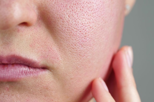 5 Rekomendasi Produk Skincare untuk Mengecilkan Pori-pori Kulit Wajah