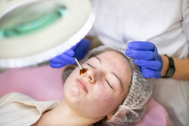 Treatment Peeling Acne Perawatan untuk Hilangkan Jerawat