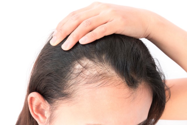 3 Hair Tonic untuk Mengatasi Rambut Rontok yang Dapat Menyebabkan Kebotakan pada Wanita