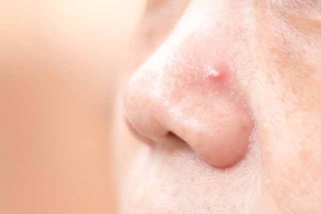 Kenalan dengan Penyebab Jerawat di Hidung dan Cara Mencegahnya