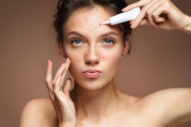 Cara Menghilangkan  Jerawat Akibat Skincare Lakukan 8 Langkah Jitu Ini