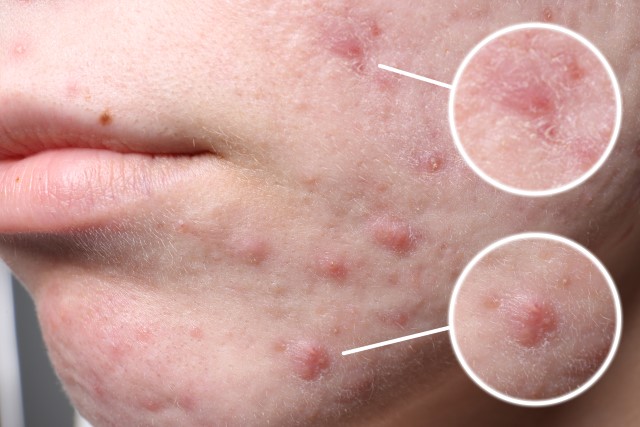 Apa Itu Acne? Bagaimana Cara Mencegahnya? Yuk Simak Biar Gak Bingung!